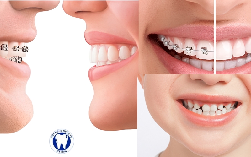 Răng thưa hình thành do nhiều nguyên nhân, từ cấu trúc răng đến sai lệch vị trí hoặc bệnh lý nha ch