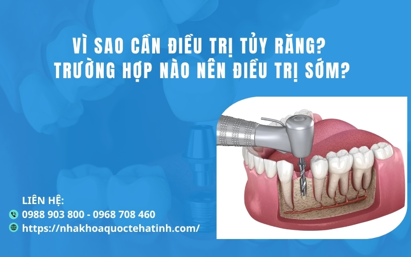Vì sao cần điều trị tủy răng? Trường hợp nào nên điều trị sớm?