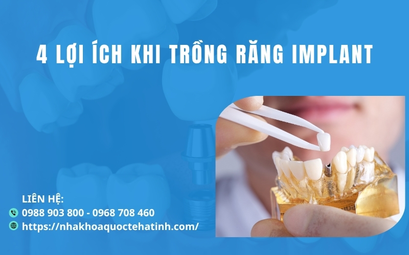 4 lợi ích khi trồng răng implant