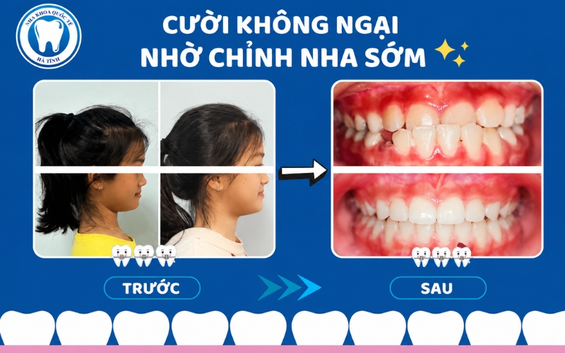 Niềng răng có thể thay đổi đường nét khuôn mặt, giúp nụ cười và tổng thể hài hòa hơn