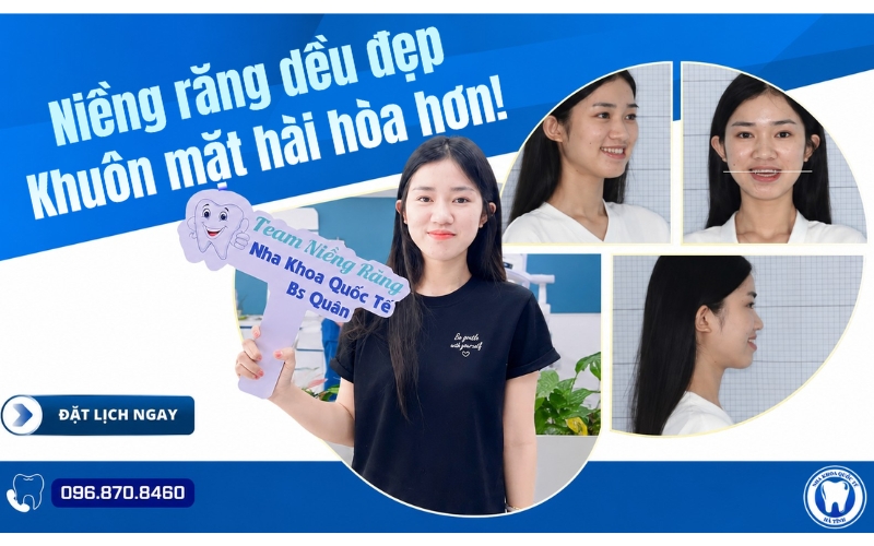 Niềng răng đúng phác đồ, chăm sóc tốt giúp răng đều đẹp và khuôn mặt hài hòa, cân đối hơn