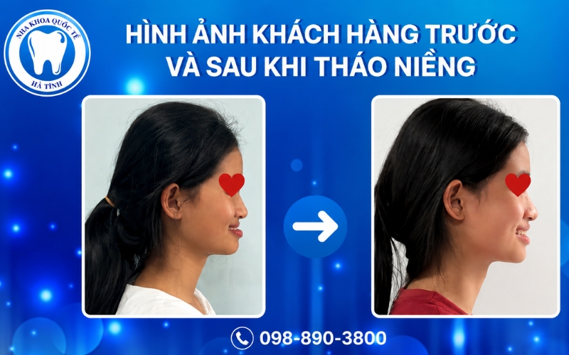 Niềng răng giúp điều chỉnh răng, môi và khớp cắn, từ đó khuôn mặt cân đối, hài hòa hơn