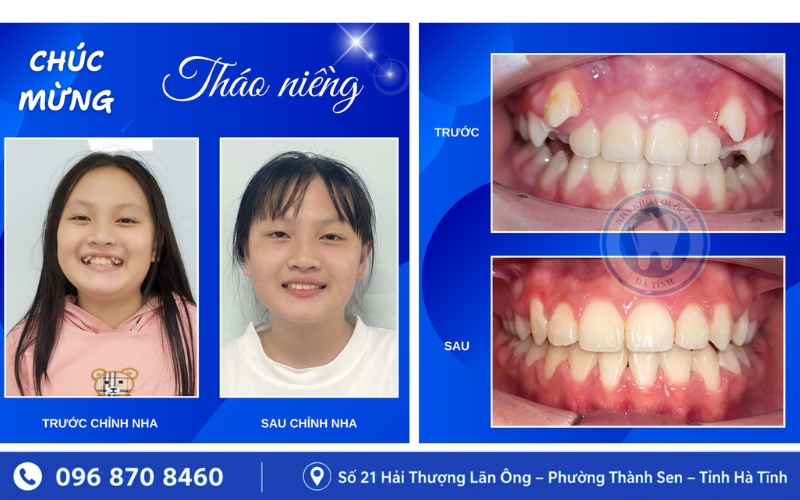 Mặt lệch hoặc hóp khi niềng răng thường chỉ là thay đổi tạm thời trong quá trình chỉnh nha