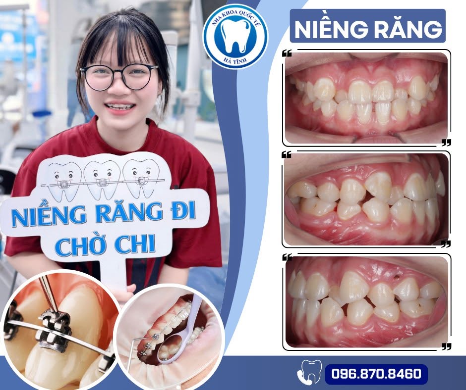 Niềng răng đúng cách giúp răng đều đẹp, cải thiện khớp cắn và nâng cao sự tự tin lâu dài.