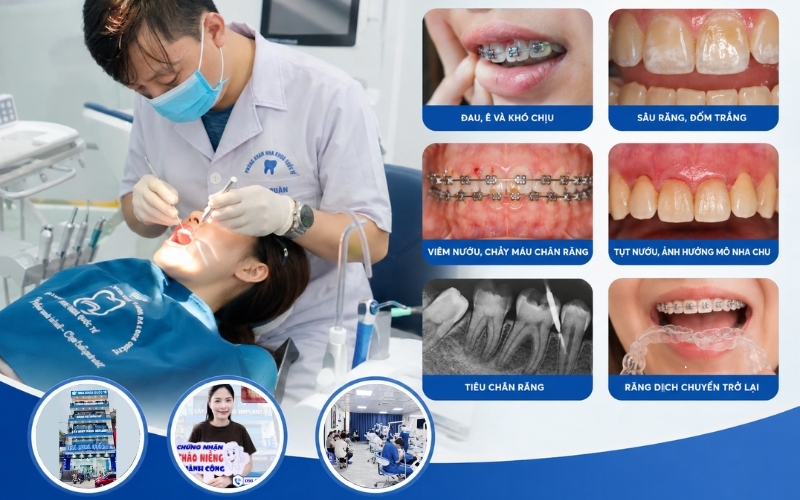 Niềng răng có thể gây một số tác dụng phụ, nhưng hoàn toàn có thể kiểm soát nếu điều trị đúng cách
