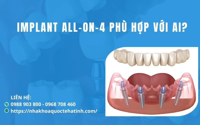 Implant All on 4 phù hợp với ai?
