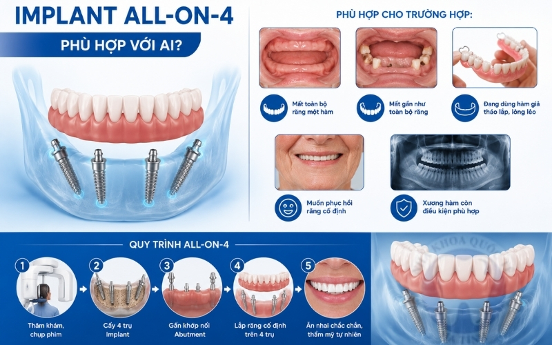 Implant All on 4  phù hợp với người mất nhiều răng, mất toàn hàm và muốn phục hồi răng cố định