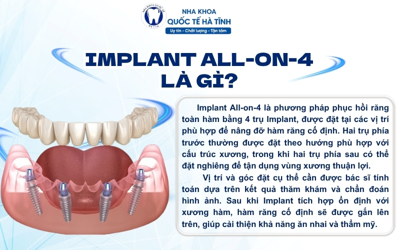 Implant All on 4 phục hồi răng toàn hàm bằng 4 trụ Implant, giúp cải thiện ăn nhai và thẩm mỹ hiệu quả