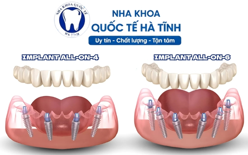 So sánh Implant All-on-4 và All-on-6 giúp lựa chọn phương án phục hồi răng toàn hàm phù hợp
