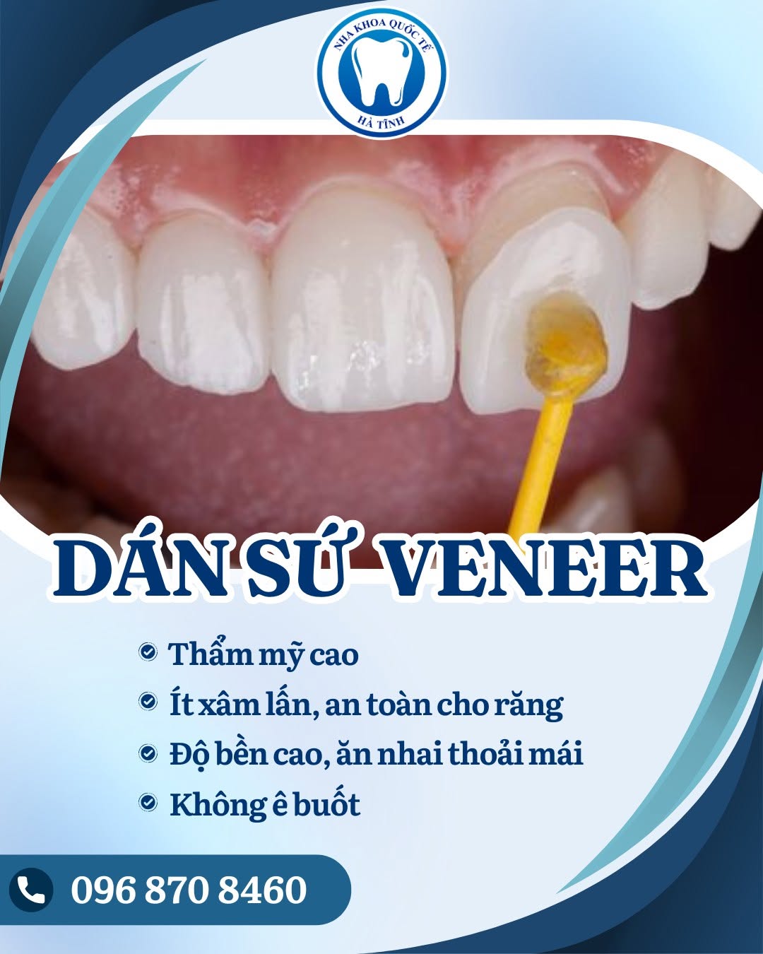 Dán sứ Veneer giúp cải thiện màu sắc, hình dáng răng và bảo tồn tối đa mô răng thật