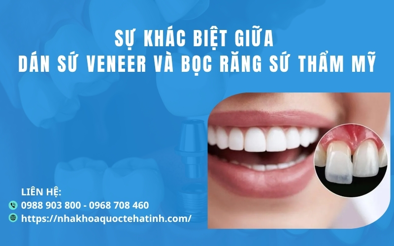 Sự khác biệt giữa dán sứ Veneer và bọc răng sứ thẩm mỹ