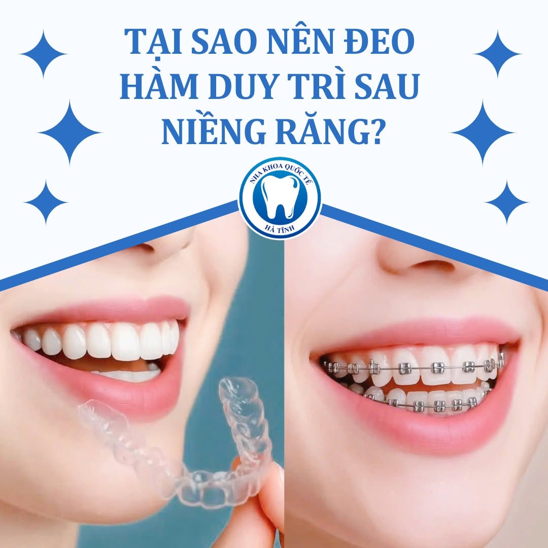 Hàm duy trì giúp giữ răng ổn định, hạn chế tái lệch và bảo toàn kết quả chỉnh nha lâu dài