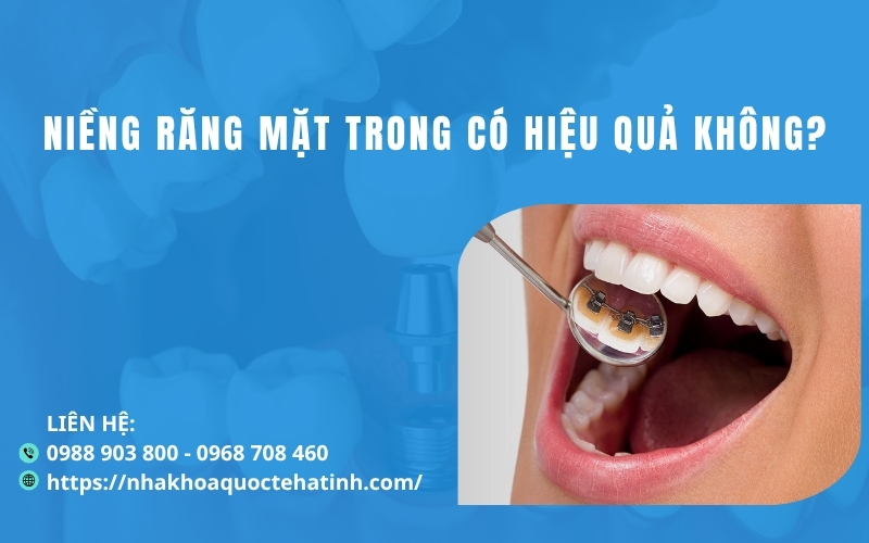 Niềng răng mặt trong có hiệu quả không?