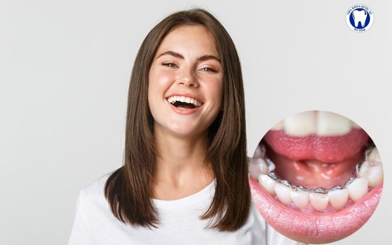 Niềng răng mặt trong giúp dịch chuyển răng, cải thiện khớp cắn mà vẫn đảm bảo tính thẩm mỹ