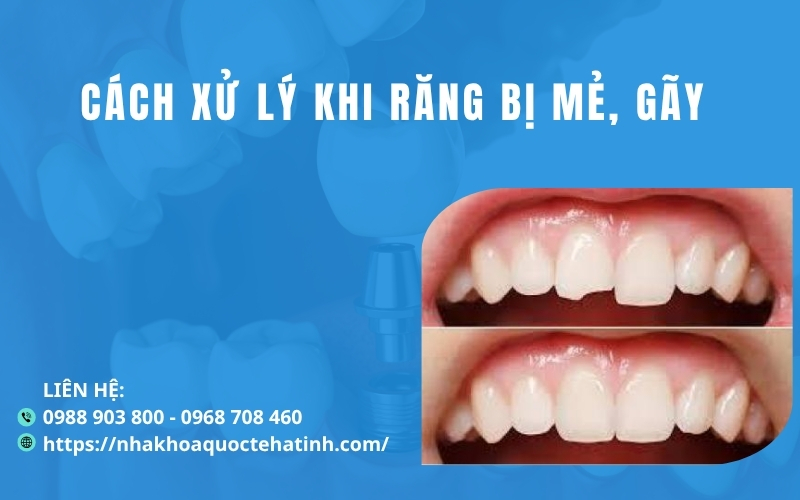 Cách xử lý khi răng bị mẻ, gãy