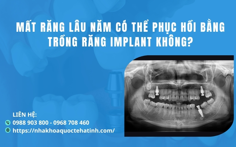 Mất răng lâu năm có thể phục hồi bằng trồng răng implant không?