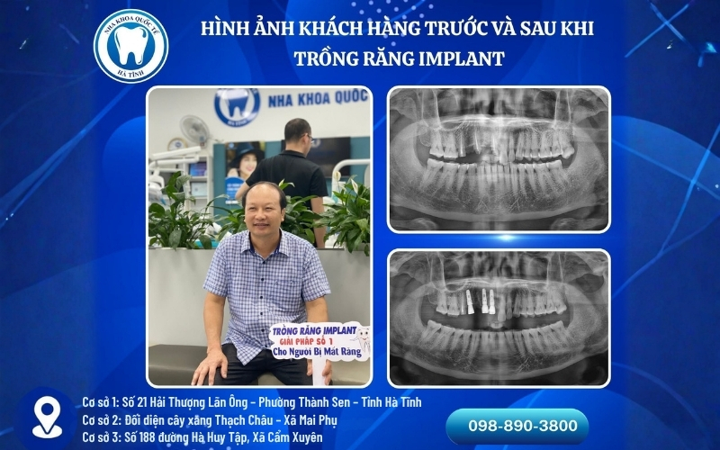Quy trình trồng răng Implant được thực hiện chuyên nghiệp, đảm bảo an toàn và phù hợp từng tình trạng mất răng