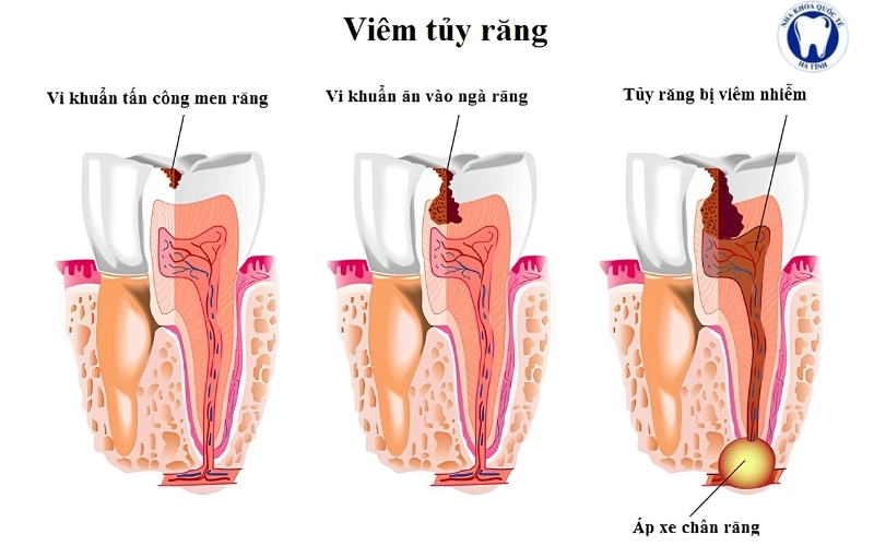 Viêm tủy răng gây đau nhức và nhiều biến chứng, cần phát hiện sớm để điều trị kịp thời